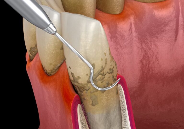 Clinique dentaire Dental smile - Villeneuve les Avignon - Dr Ghadimi - Surfacage