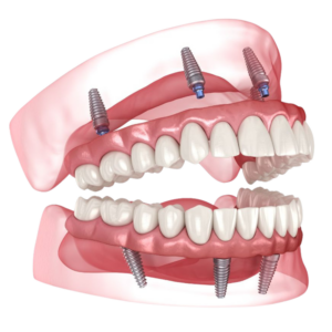 Clinique dentaire Dental smile - Villeneuve les Avignon - Dr Ghadimi - All on 4