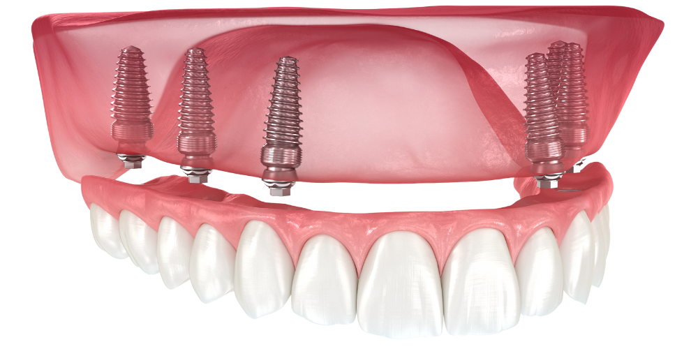 Clinique dentaire Dental smile - Villeneuve les Avignon - Dr Ghadimi - All on 6